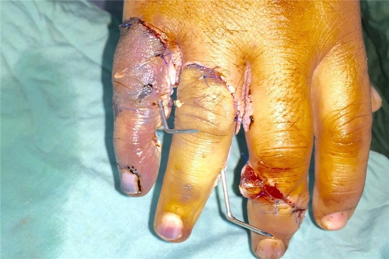 عمل پیوند دست برای نخستین بار در دهدشت انجام شد+تصویر