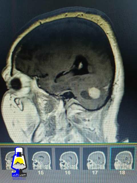عمل برداشتن تومور مغزی در دهدشت با موفقیت انجام شد