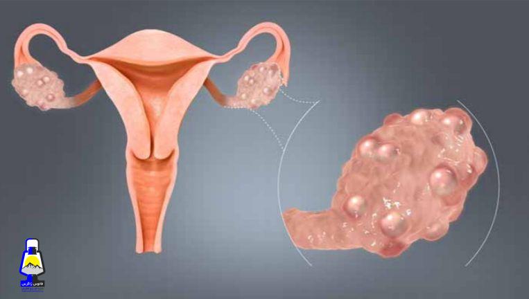 کیست تخمدان+روشهای درمان آن