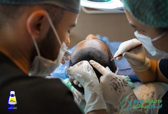 کاشت مو به روش میکروگرافت در کلینیک ایران بیوتی