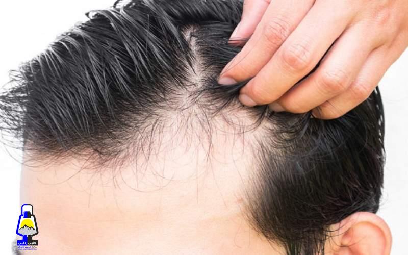 این غذا‌ها را نخورید تا ریزش مو نگیرید