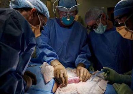 پیوند کلیه حیوان به انسان برای اولین بار در جهان