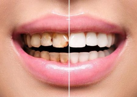 لمینت دندان چگونه است؟