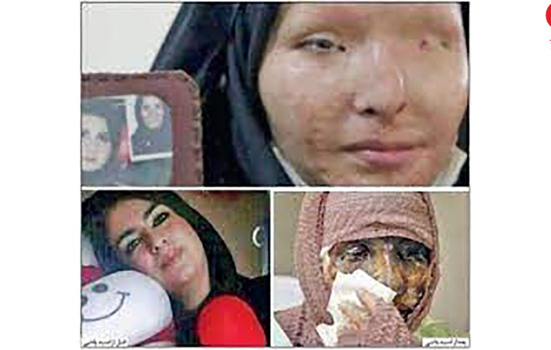 زندگی تلخ دختر دهدشتی قربانی اسیدپاشی ؛ حتی برای خرید غذا پول ندارم