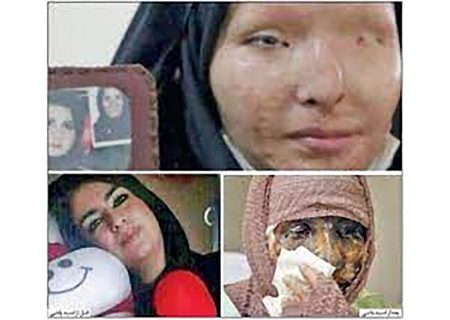 زندگی تلخ دختر دهدشتی قربانی اسیدپاشی ؛ حتی برای خرید غذا پول ندارم