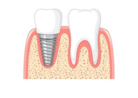 مرکز تخصصی ایمپلنت تهران