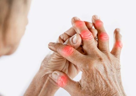 چگونه احتمال ابتلا به آرتریت را کاهش دهیم؟