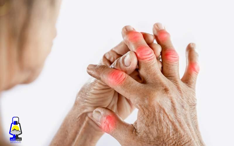 چگونه احتمال ابتلا به آرتریت را کاهش دهیم؟