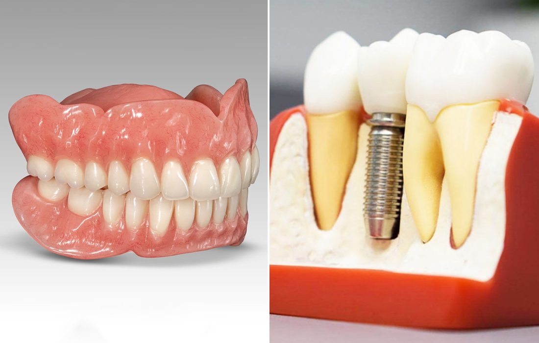 ایمپلنت دندان یا دندان مصنوعی