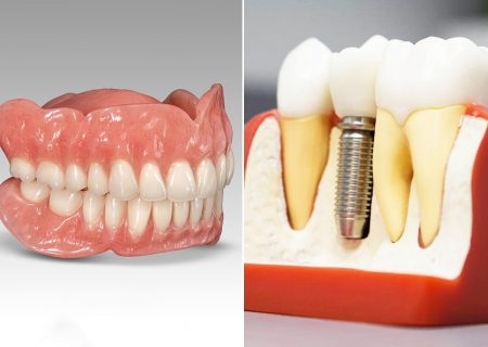 ایمپلنت دندان یا دندان مصنوعی