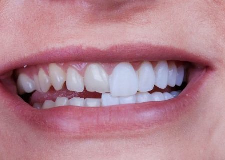 تفاوت ایمپلنت و لمینت به زبان ساده