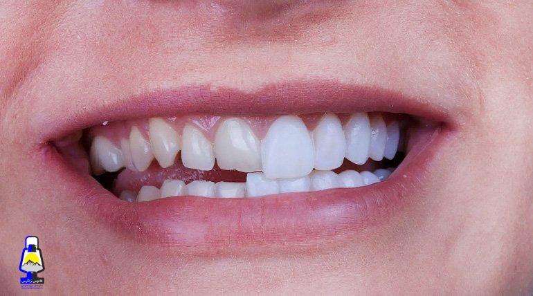 تفاوت ایمپلنت و لمینت به زبان ساده