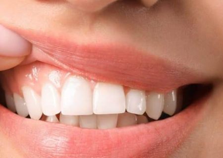 راز لبخند جذاب؛ چرا کامپوزیت دندان این‌قدر محبوب شده است؟