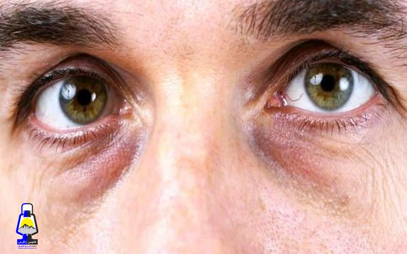 افزایش خطر بیماری‌های چشمی با افزایش سن