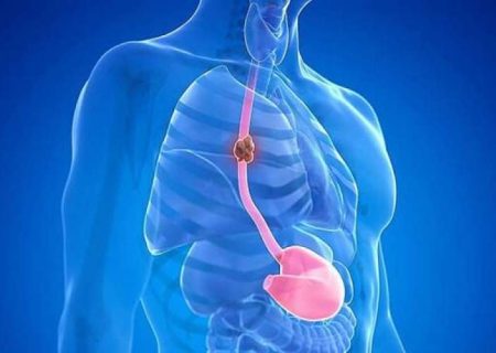 نکاتی درباره سرطان مری