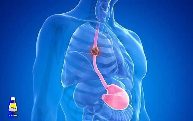 نکاتی درباره سرطان مری