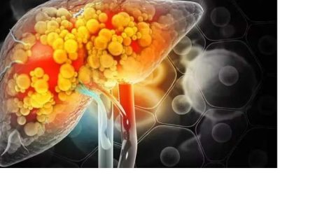 کبد چرب این علایم را در چهره نمایان می‌کند