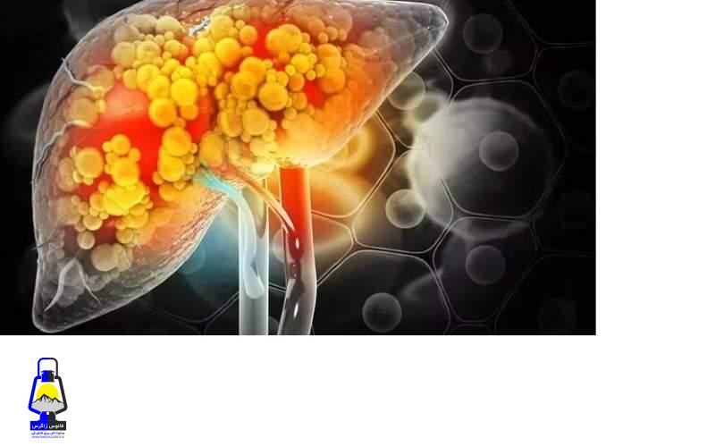 کبد چرب این علایم را در چهره نمایان می‌کند