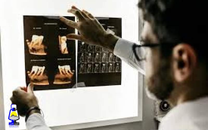 کلید مولکولی آلزایمر پیدا شد